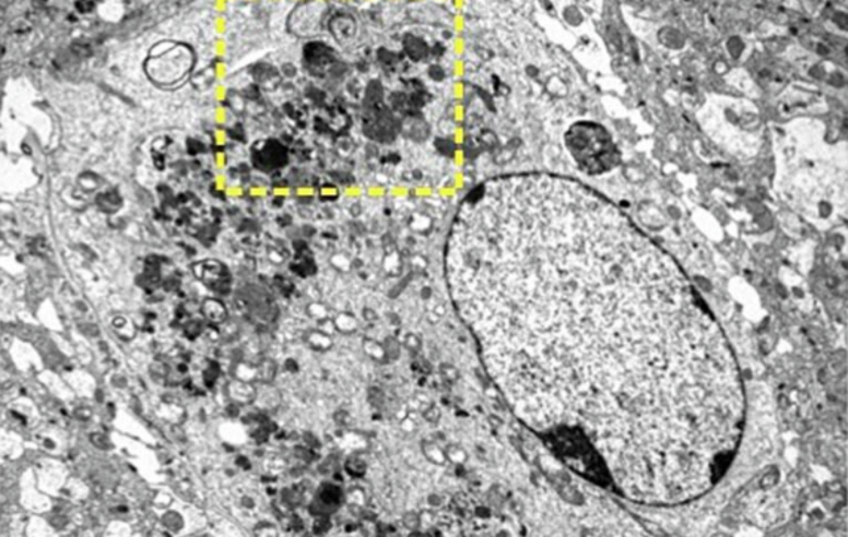 Lysosome-derived cytoplasmic organelles accumulate in reactive astrocytes